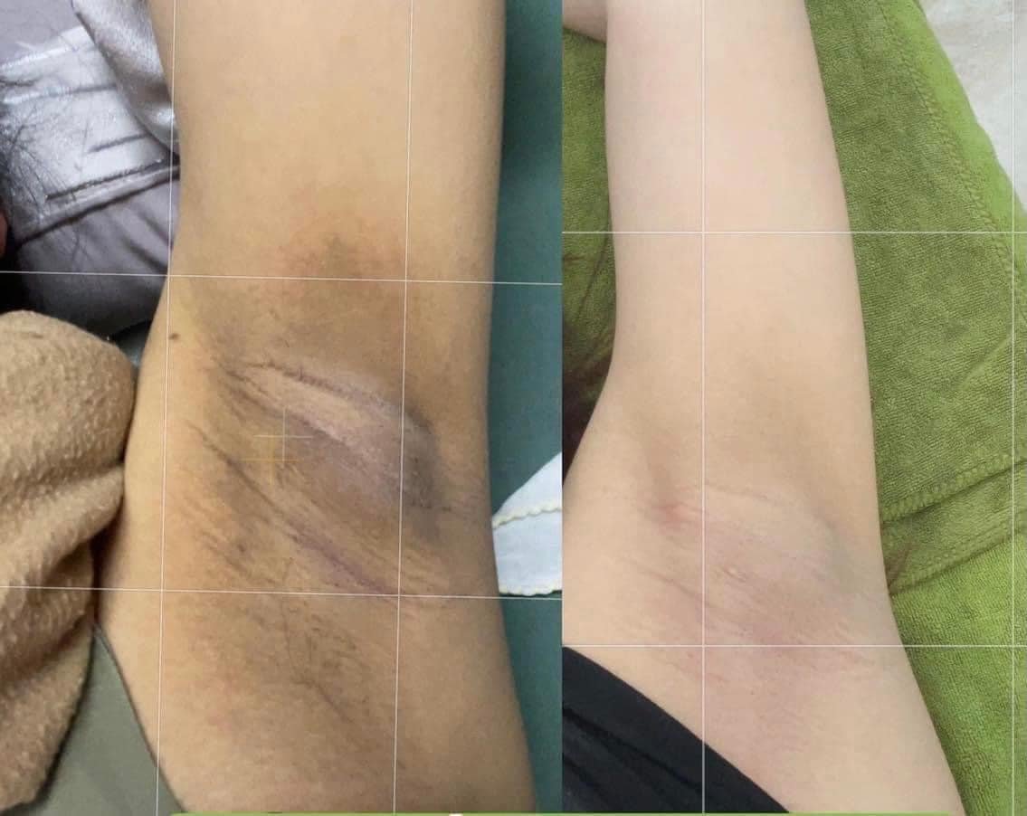 20656-17777-z3774624583299-754f4555320494fbb38884f2bb4d8b91-7.jpg Kem Giảm Thâm Nách Q Nic Care Thái Lan Phiên Bản Mới - QNIC01