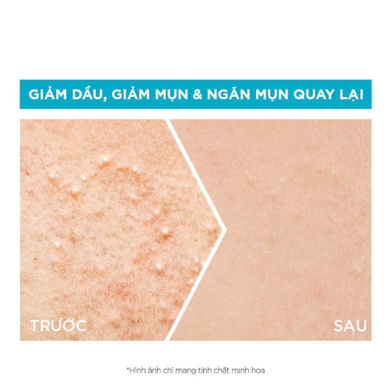 25366_phu-photoroom-6_20241005174732-2.png Serum Garnier Giảm Mụn Sáng Da Skin Naturals Bright Complete Anti-Acne Booster Serum 30ml - 8994993018390