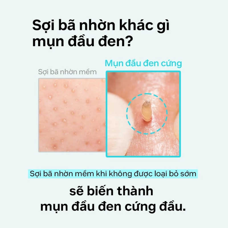 25805_tinh-chat-ilso-phu-photoroom-5_20241122165228-1.png Tinh Chất Ủ Mụn Đầu Đen ILSO Super Melting Sebum Softener 150g Giúp Sạch Bã Nhờn Sáng Da - 8809635332010