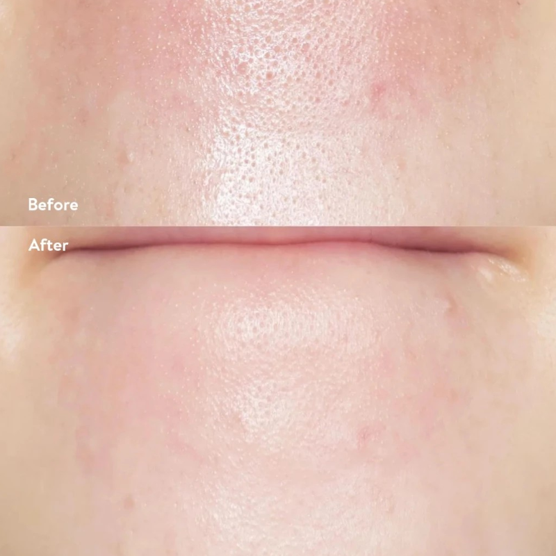 25805_tinh-chat-ilso-phu-photoroom-7_20241122165227-1.png Tinh Chất Ủ Mụn Đầu Đen ILSO Super Melting Sebum Softener 150g Giúp Sạch Bã Nhờn Sáng Da - 8809635332010