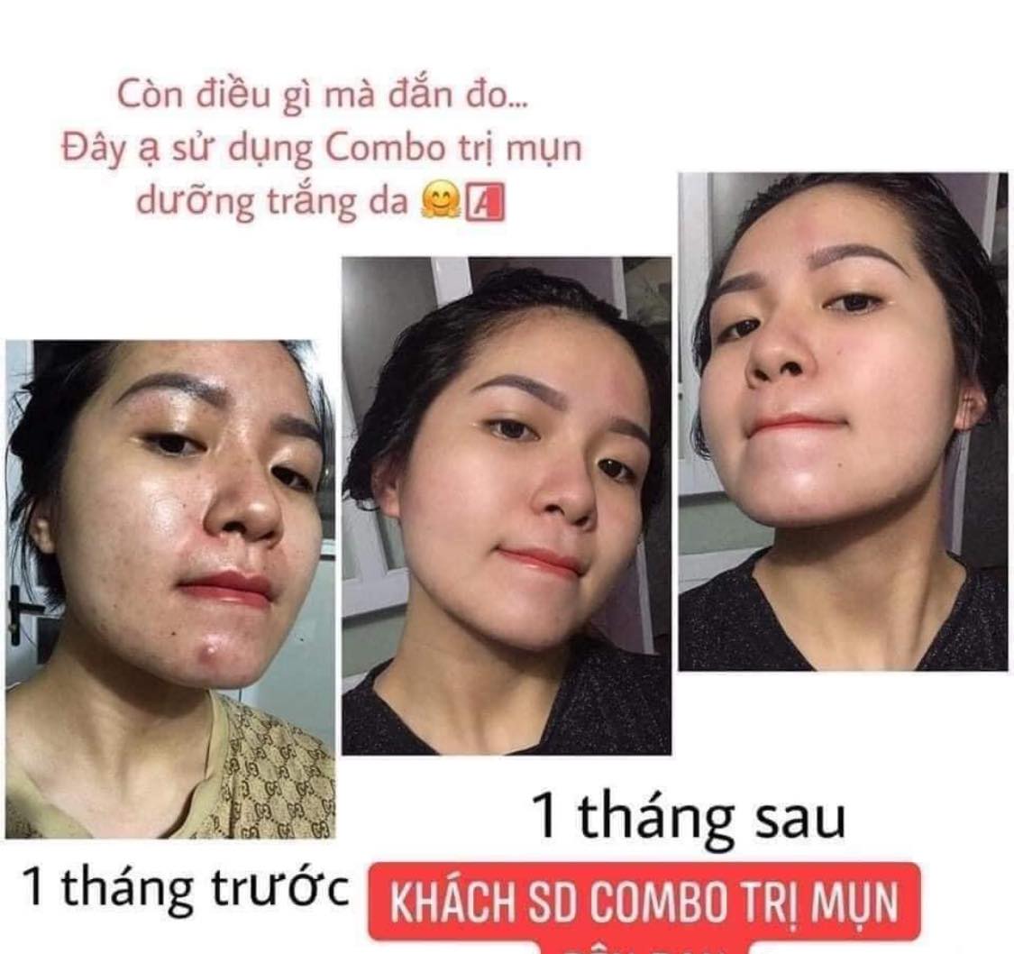 Trị mụn không khó chỉ sợ không chịu khó với A Cosmetics Phương Anh