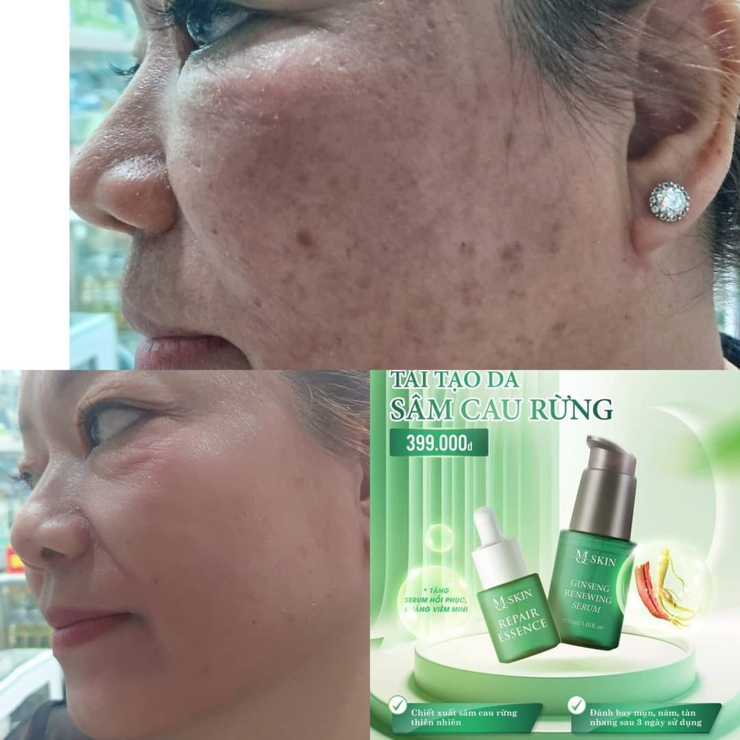 Combo Tái Tạo Sâm Cau Rừng MQ Skin