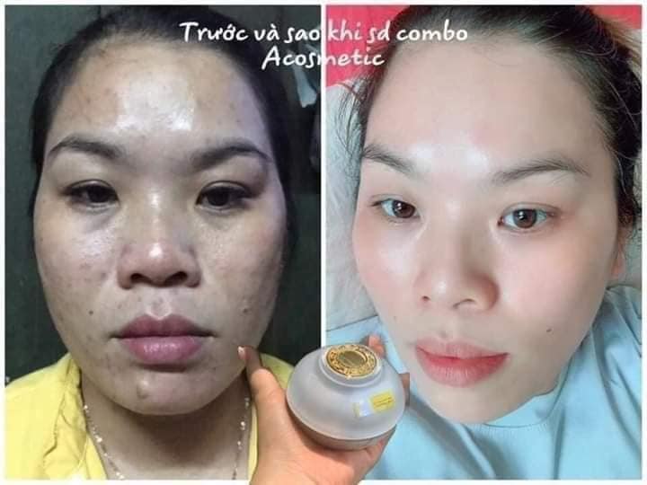 Sạch bay mụn thâm chỉ với 1 hộp kem FACE PHÁP